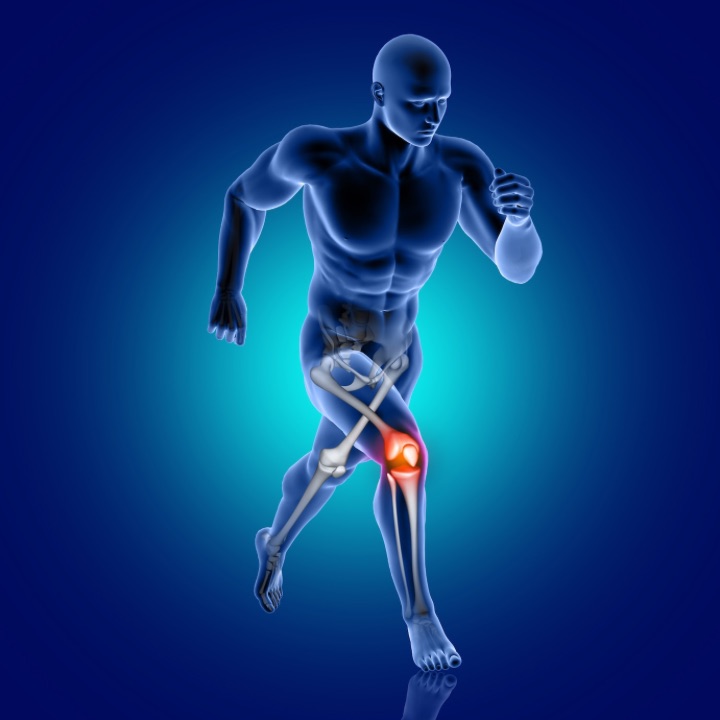 patellar dislocation highlighter in a 3D male medical figure running