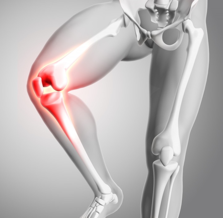 knee arthritis illustration