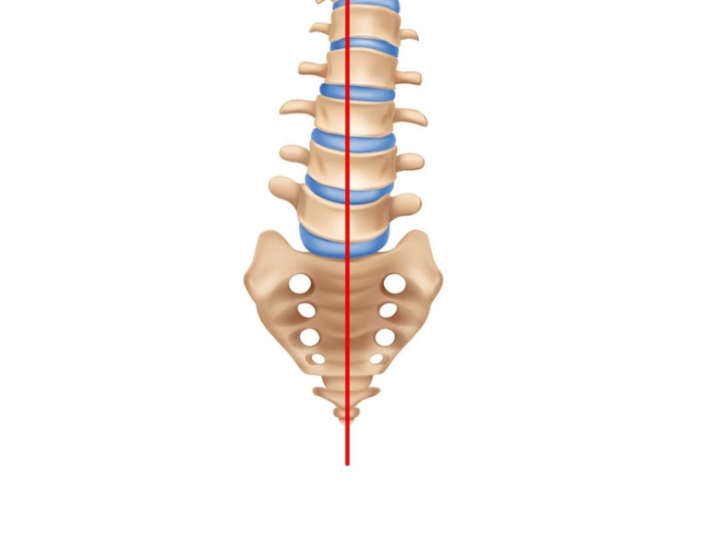Spondylolisthesis occurs in the lower back