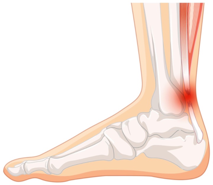 Achilles tendon rupture illustration