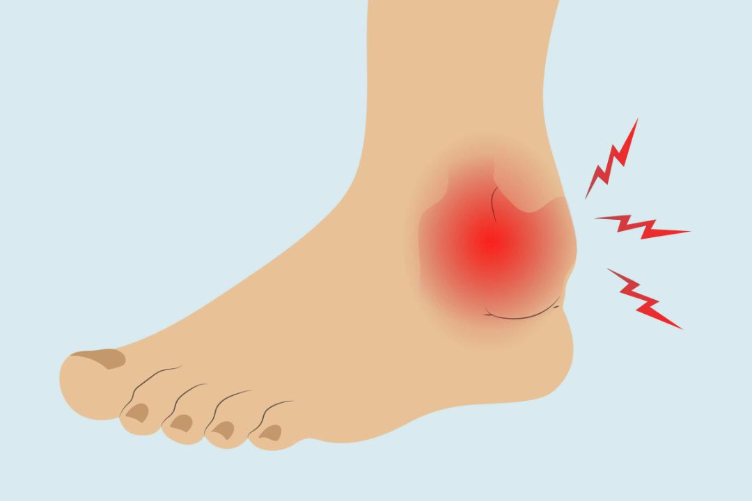 Ankle Arthritis: Causes, Symptoms, Diagnosis