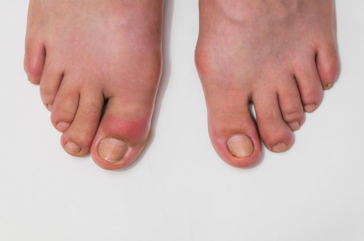 An image of two feet of a person affected by gout in their big toes.