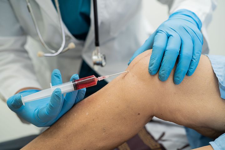 A doctor injecting hyaluronic acid rich platelet into a patient's knee suffering from arthritis.