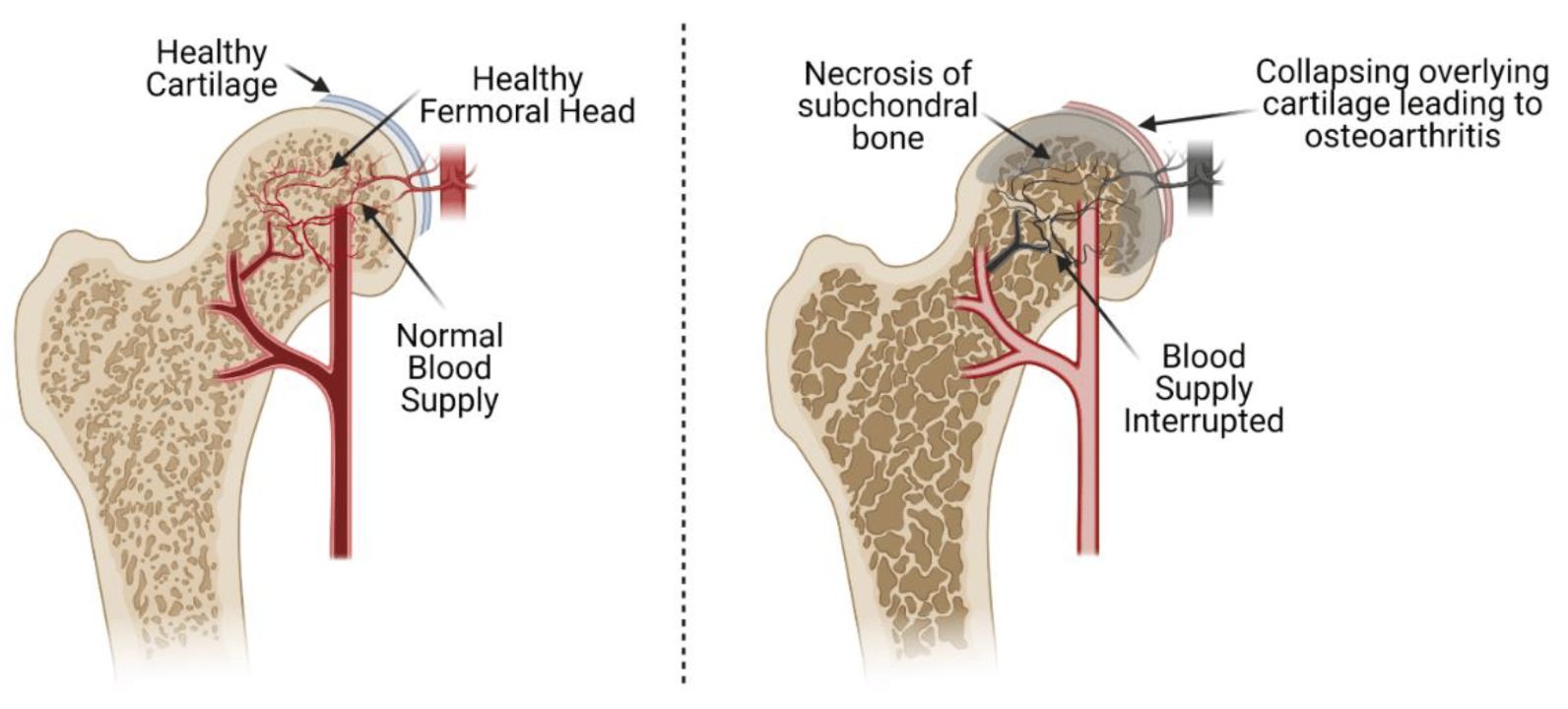 Surgery can be a solution for avascular nbirecrosis of the femoral head.