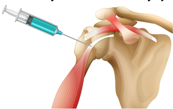 steroid injection can help with treatment of biceps tendinopathy