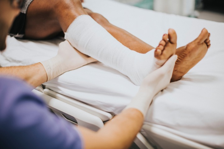 achilles tendon rupture being helped by a cast