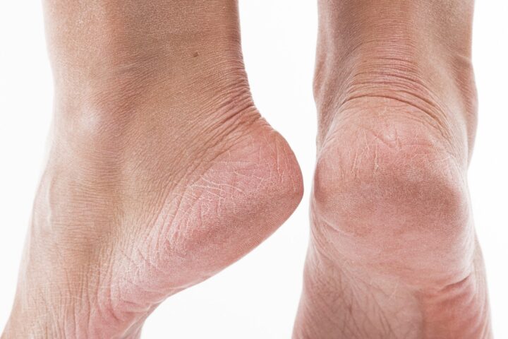 Dehydrated skin on the heels of female feet