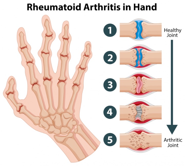 rheumatoid arthritis and fibromyalgia share similar symptoms