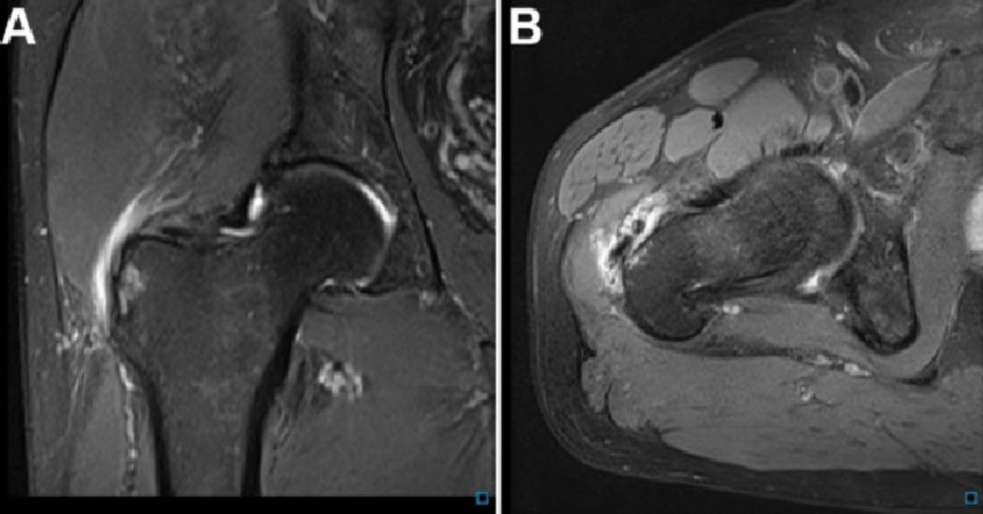 MRI and Ultrasound in Diagnosing Gluteal Tendinopathy.