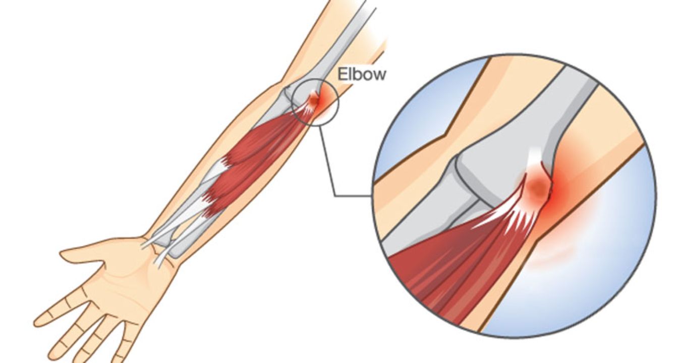 What is Golfer's Elbow? Understanding Elbow Tendon Injuries in a Golfer