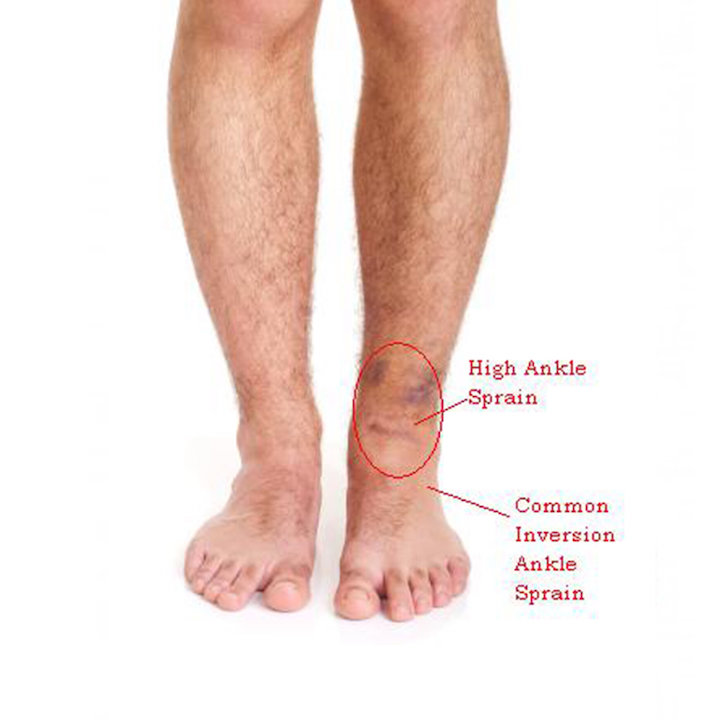 A picture of a man's feet labeling the locations of a high ankle sprain and a common inversion ankle sprain with red markers.