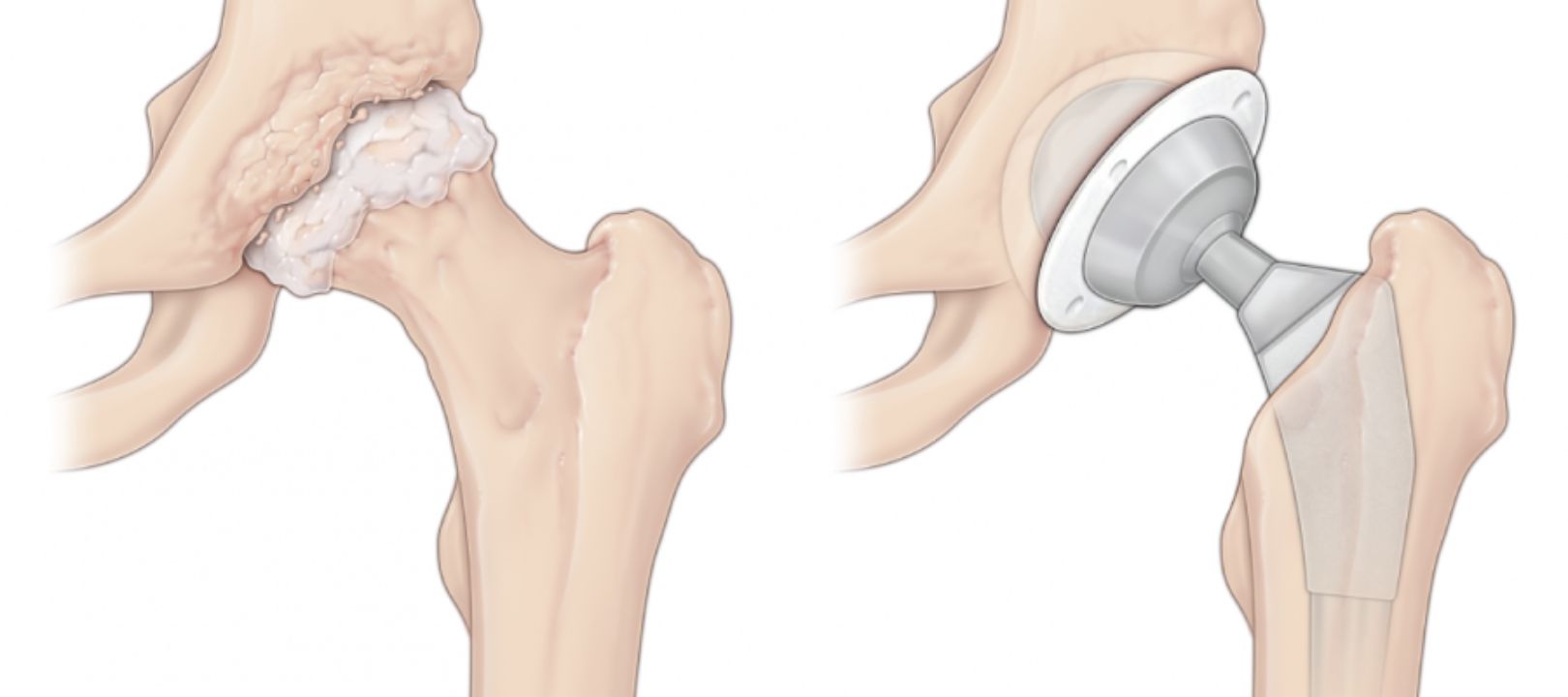 Before and after graphic of hip replacement surgery.