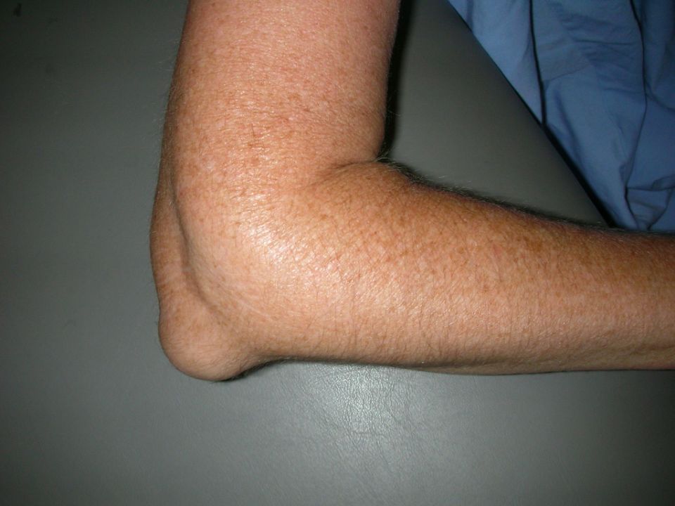 Olecranon Bursitis: Signs and Symptoms of Elbow Bursitis (Inflamed Bursa)