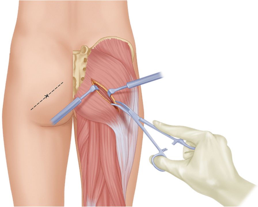 Surgery is a final option for Piriformis Syndrome.