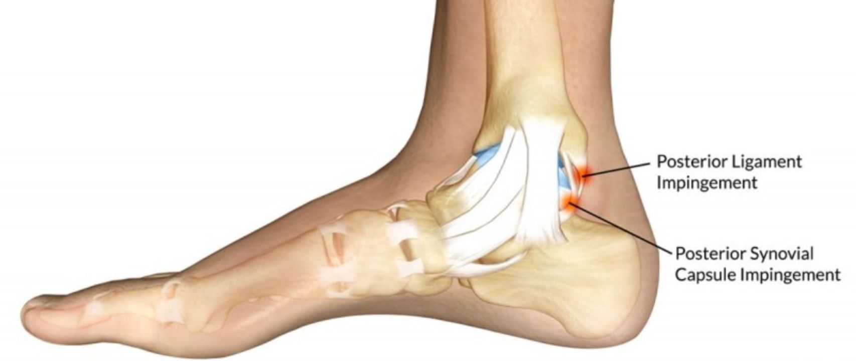Treatment Options for Posterior Ankle Impingement