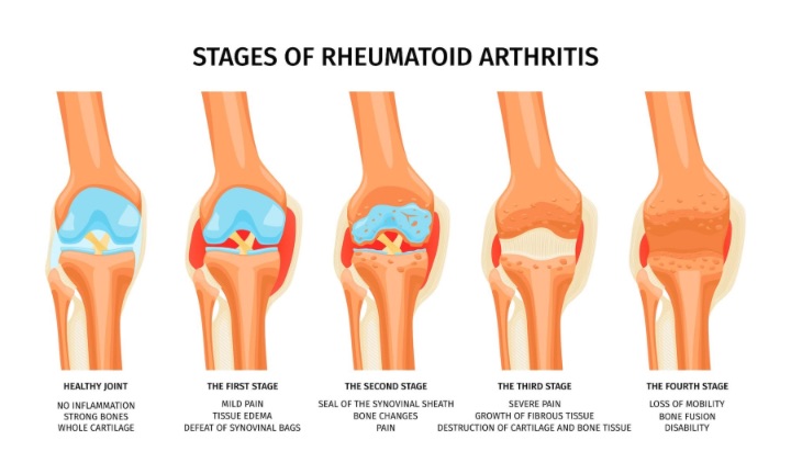 infographics showing four stages of rheumatoid arthritis knee joint illustration