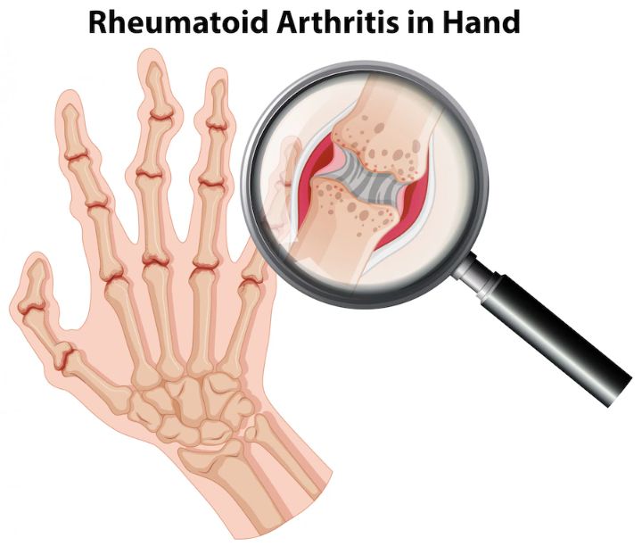rheumatoid arthritis in the hand illustration