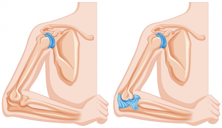 Rotator cuff tendinopathy pain