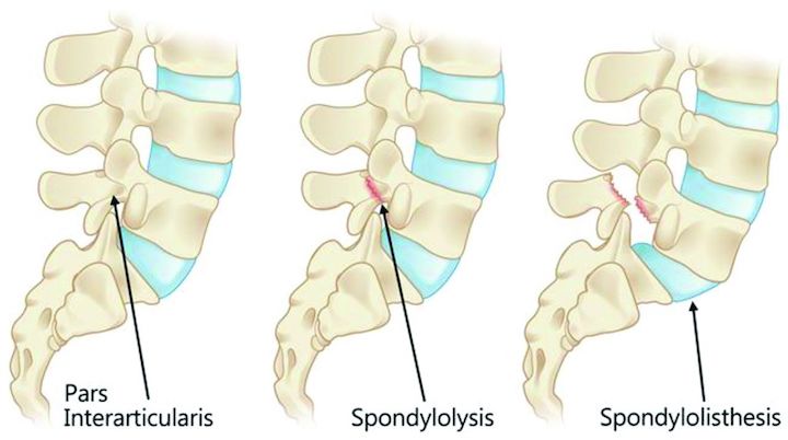 An illustration showing the difference between spondylolysis and spondylolisthesis as well as a normal lumbar spine region.