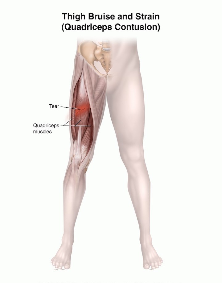An illustration of a leg showing an example of quadriceps contusion in the muscle.