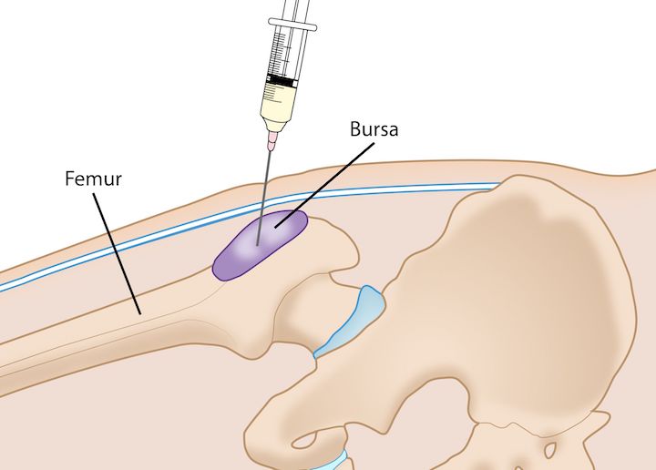 An image illustration depicting an injection to the trochanteric bursa.