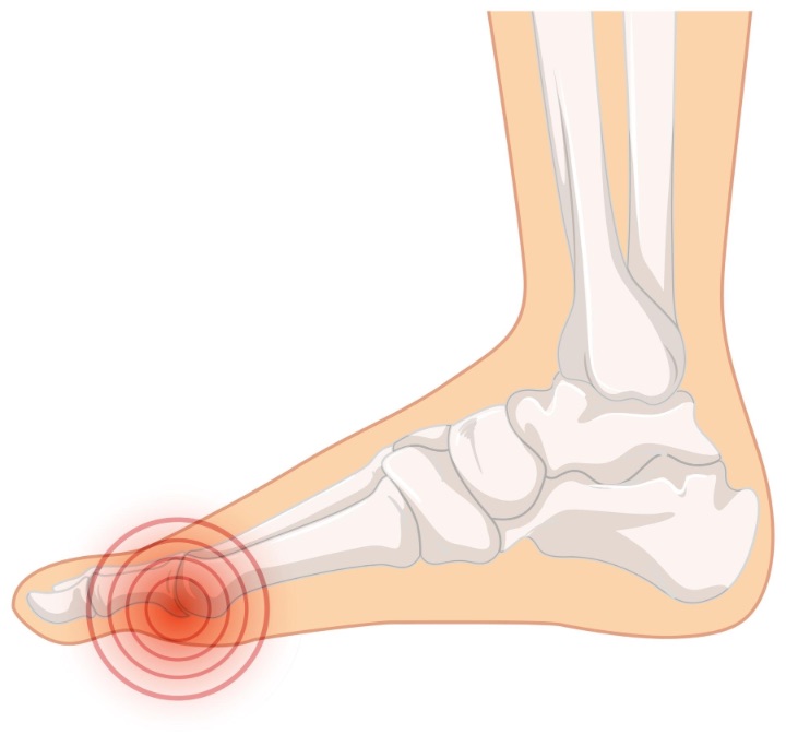 bunions is a condition of the foot also known as hallux valgus