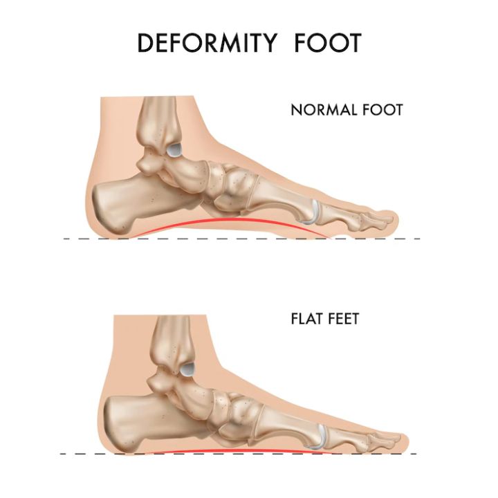 flat feet is a collapsed arch deformity causing discomfort to the feet