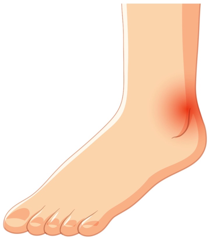 FHL tendinopathy foot pain