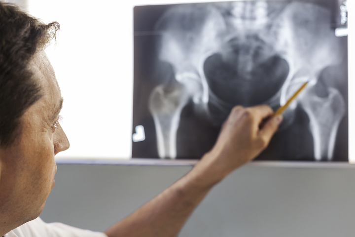 A doctor pointing at an X-ray of the pelvis area of his patient.