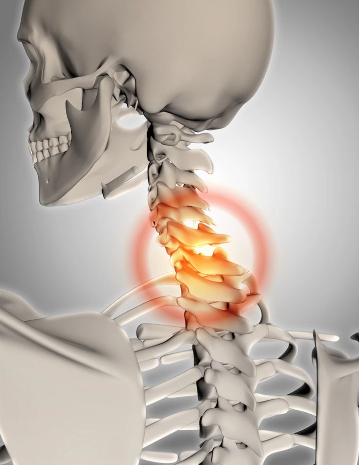 Herniated cervical disc is one of the causes of cervical radiculopathy