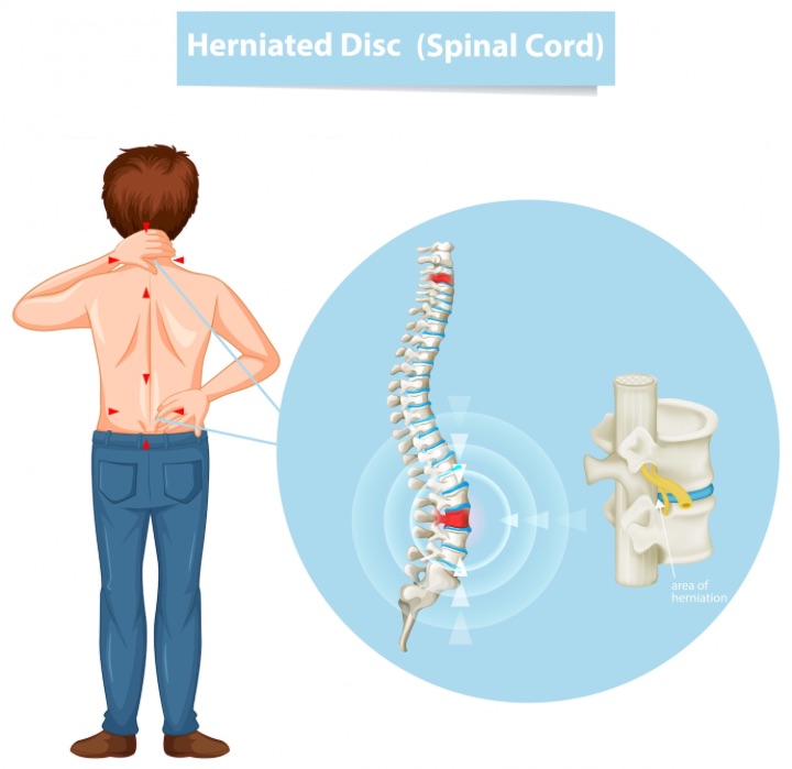herniated disc is one of the factor of degenerative disc disease