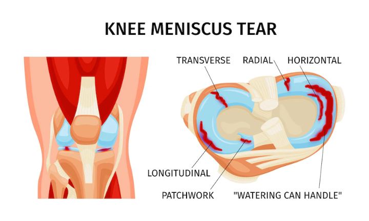 Knee meniscus tear shown in the anatomical illustration