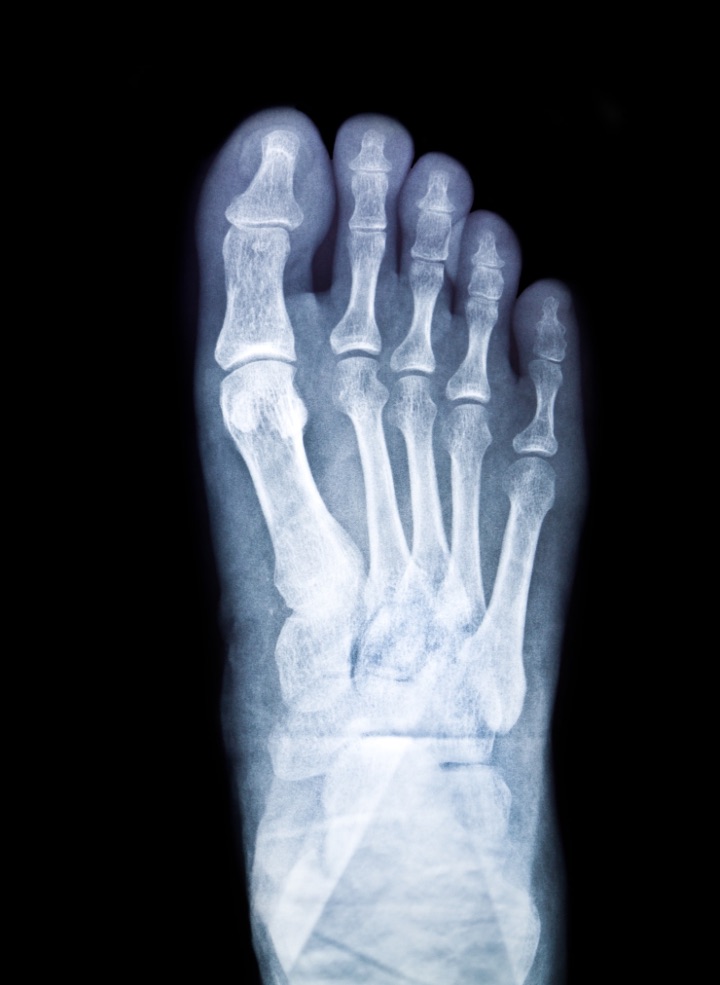 Morton's Neuroma is diagnosed  with the help of x-ray