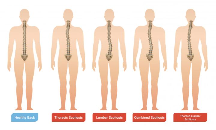 Scoliosis is the curvature of the spine and there are different types of scoliosis as illustrated
