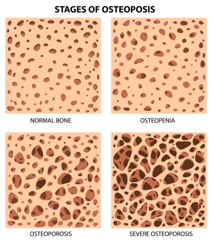 different stages of osteoporosis illustration