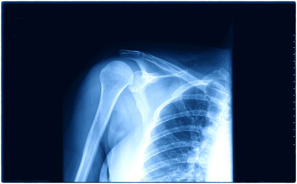 X-ray image of human fractured shoulder