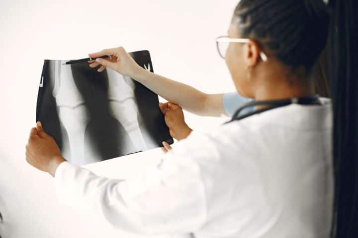 X-ray MRI and other imaging techniques can be used to diagnose PCL injury