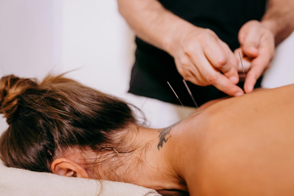 A woman undergoing acupressure therapy aimed at relieving back pain, utilizing dry needling methods for effective treatment.