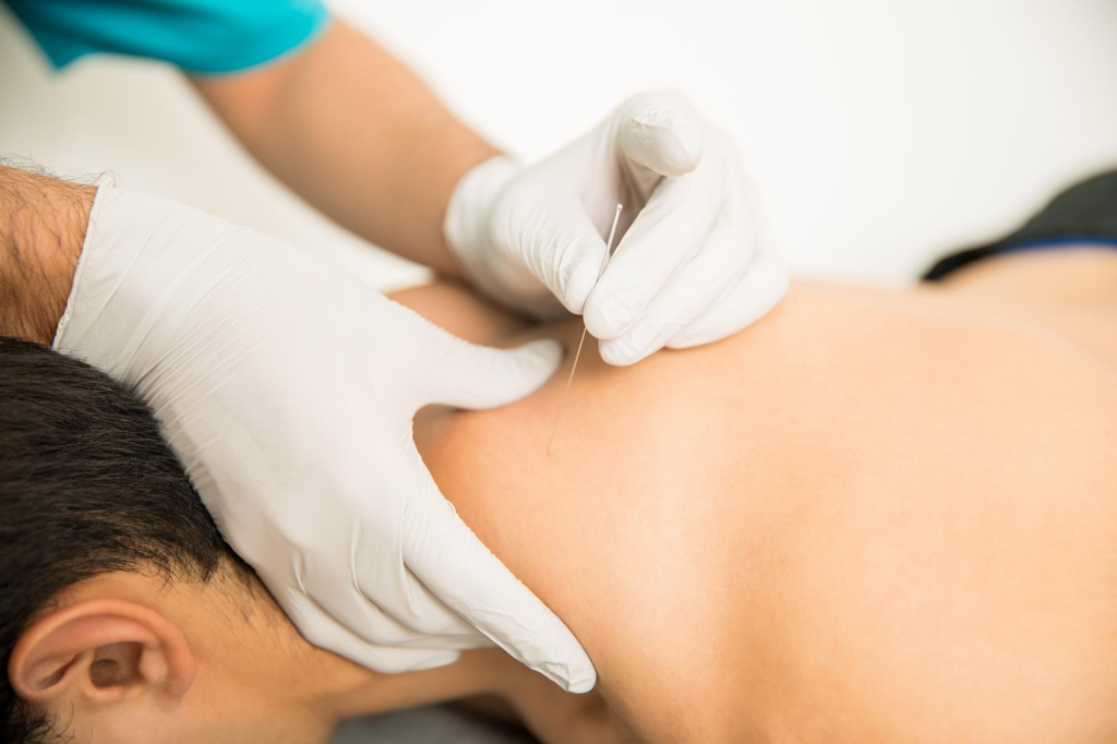 A therapist performing dry needling on a patient’s shoulder to relieve muscle pain and tension. Learn how long dry needling takes to work for results.