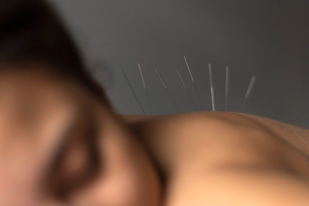 A serene acupuncture session targeting back pain, showcasing needles placed along the spine for relief and healing.