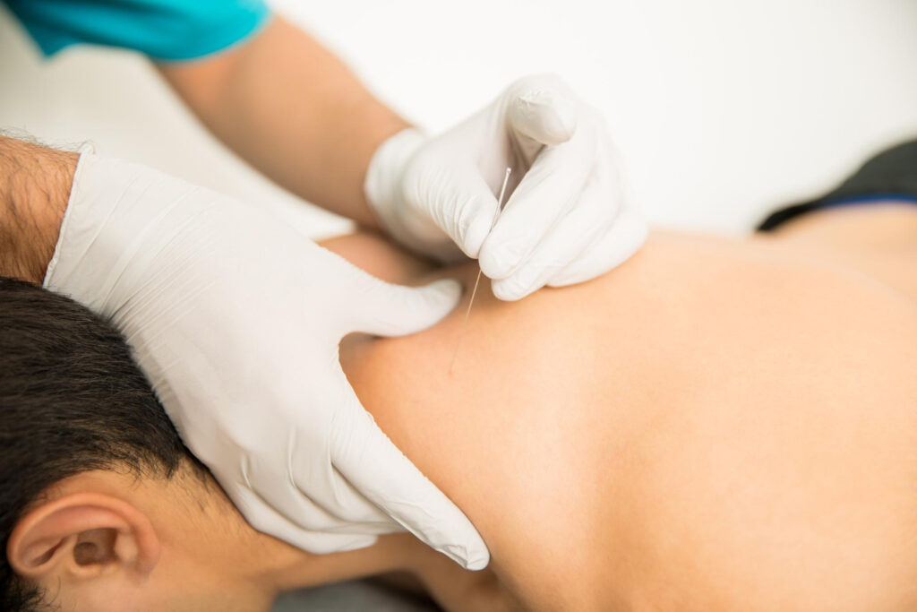 A man receiving acupuncture treatment, focusing on key acupressure points to relieve neck pain.